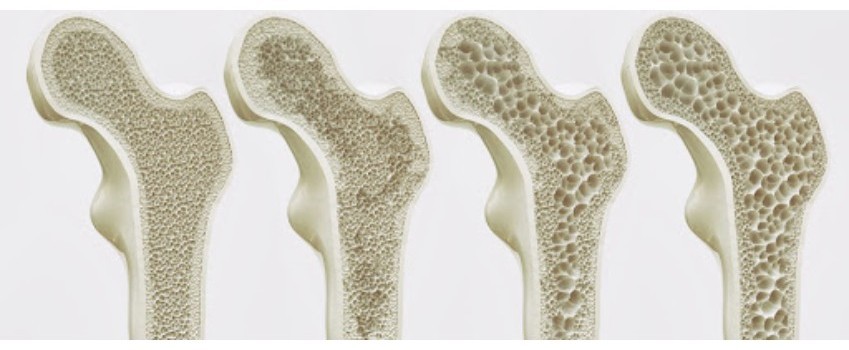 OSTEOPOROSI
